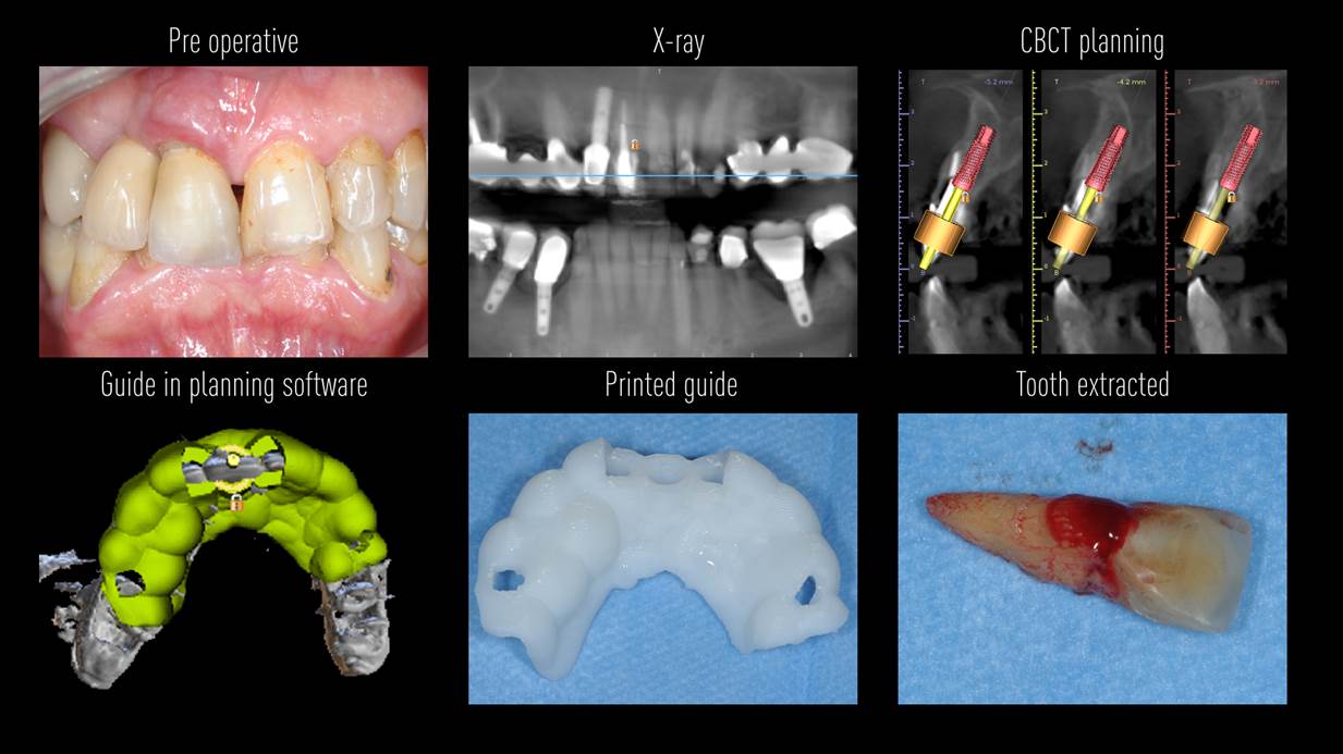 Immediate-Implant-Placement